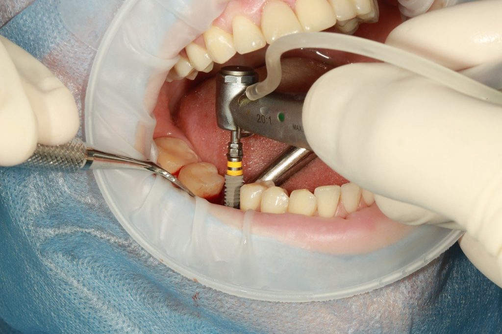 cirurgia implante dentário