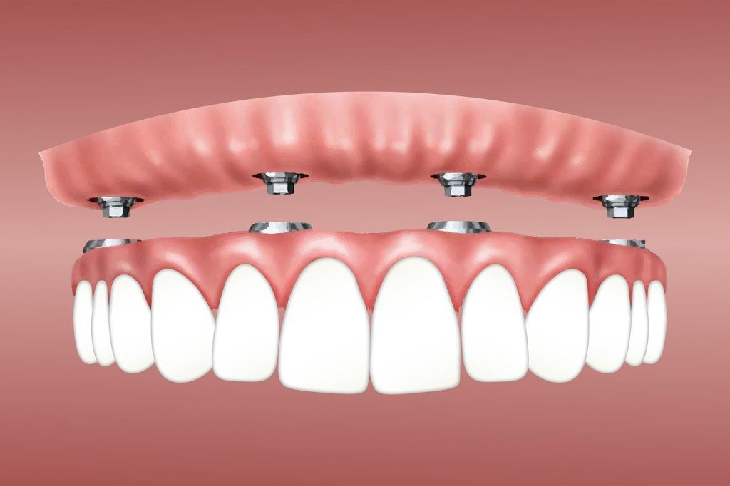 o que é implante dentário